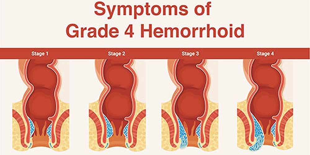 Stages of hemorrhoids