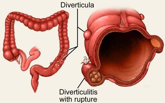 diverticulitis